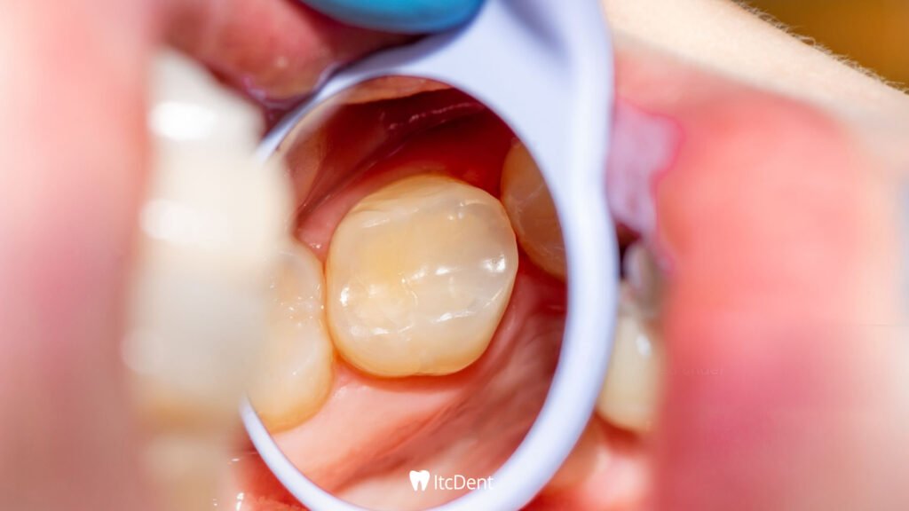 What is a Composite Filling?