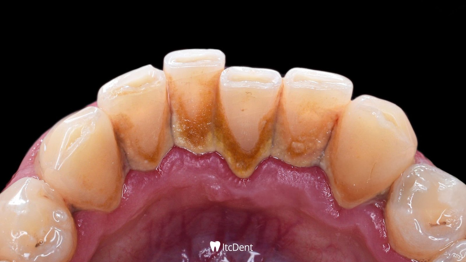 Why Does Tartar Form