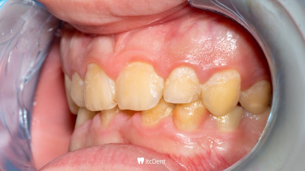 Why Does Tartar Form