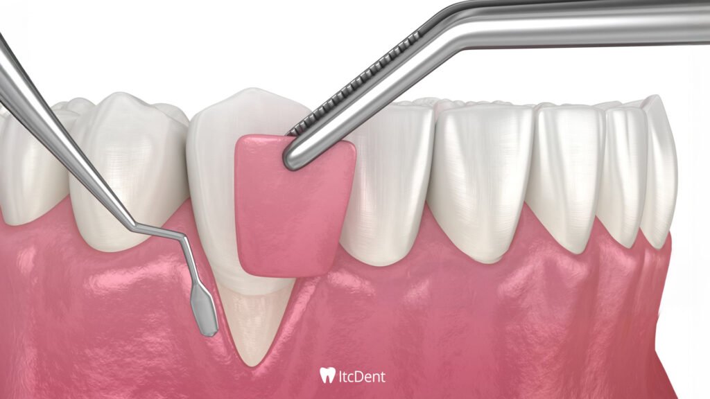 Flap Operasyonu Nedir? 