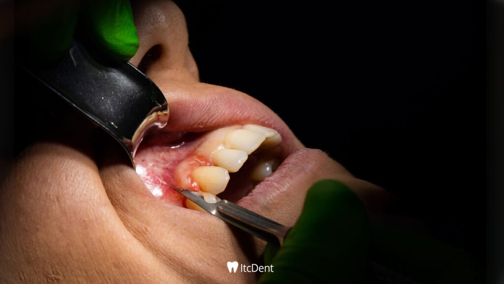 Flap Operasyonu Nedir? 