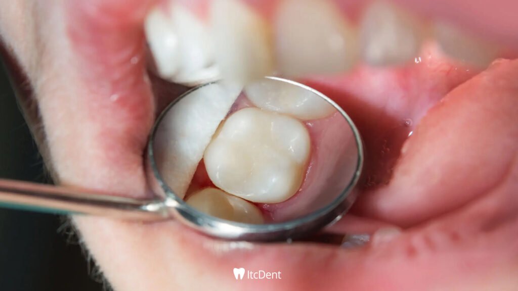 Diş Dolgusunun Ömrü Ne Kadardır